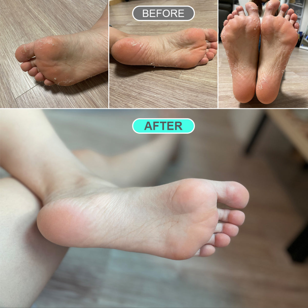 Treating peeling clearance feet